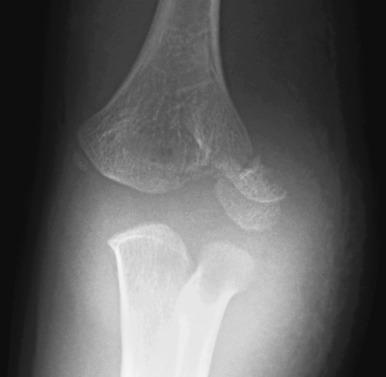 e-Figure 142.24, Displaced lateral condylar fracture in a 6-year-old boy.