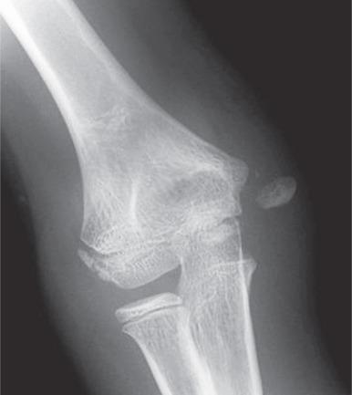 Figure 142.25, Avulsed medial epicondyle in an adolescent boy.