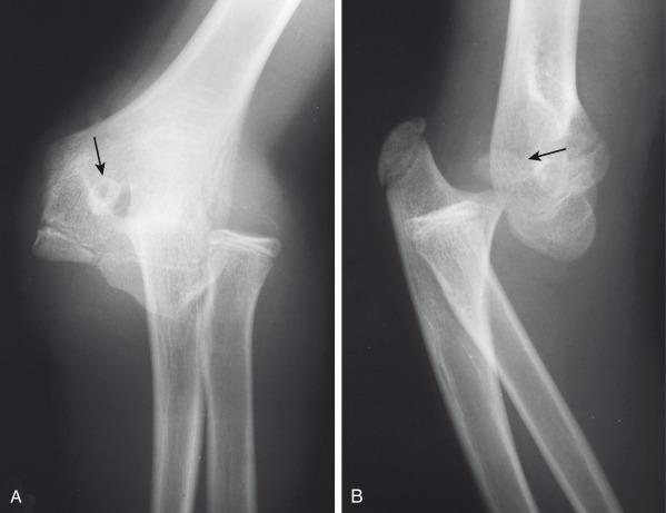 e-Figure 142.26, Elbow dislocation in a 12-year-old boy.