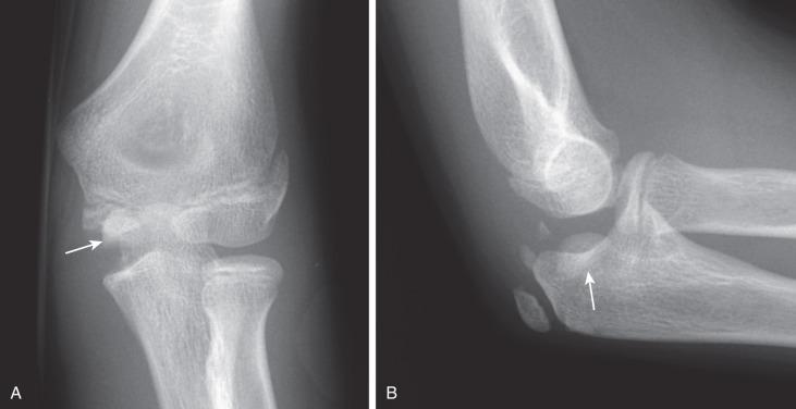 Figure 142.27, Avulsed medial epicondylar entrapment.