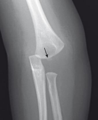 e-Figure 142.28, Salter-Harris I fracture (transcondylar fracture) of the distal humerus in a 16-month-old boy.