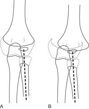 e-Figure 142.29, Separation of the entire distal humeral epiphysis.