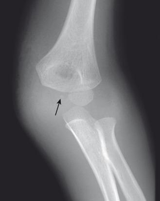 e-Figure 142.30, Elbow dislocation in a 5-year-old boy.