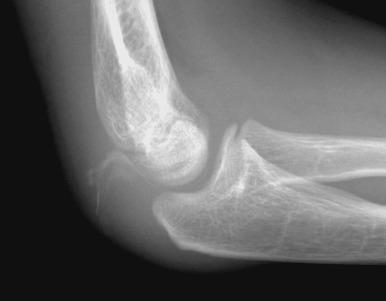 e-Figure 142.32, Olecranon sleeve fracture in an 11-year-old boy.