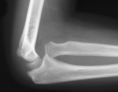 e-Figure 142.33, Radial head dislocation in a 9-year-old girl.