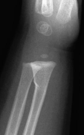 Figure 142.4, Buckle fracture of the distal radius in a 19-month-old boy.