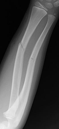 Figure 142.5, Greenstick fractures of the radial and ulnar diaphyses in an 8-year-old boy.