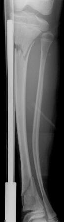 e-Figure 142.6, Bowing fracture of the fibula in a 12-year-old boy.