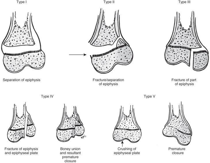 Figure 142.7, Injuries to the cartilage plate classified according to Salter and Harris.