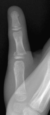 Figure 142.9, Salter-Harris II fracture of the proximal phalanx of the thumb in a 10-year-old boy.