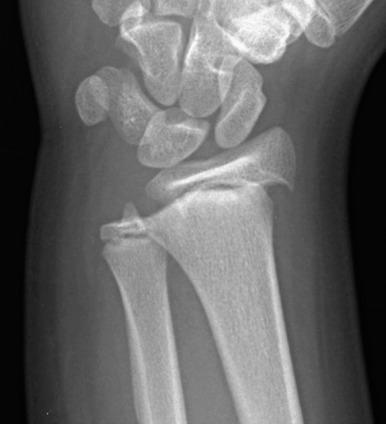 e-Figure 142.8, Apparent Salter-Harris I fracture of the distal radius in an 11-year-old girl.