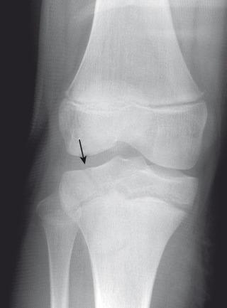 e-Figure 142.10, Salter-Harris III fracture of the proximal tibia in a 10-year-old girl.