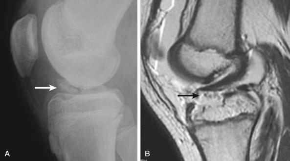 Fig. 19.2, Radiograph (A) and magnetic resonance image (B) of a displaced tibial spinal fracture.