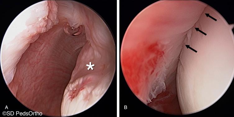 Fig. 19.3, A 17-year-old football player with multiple recurrent dislocation events and a large Hill-Sachs lesion (A) seen in an arthroscopic photo (asterisk) , and (B) the same photograph after remplissage procedure brings the infraspinatus and posterior capsule into the defect (arrows) .