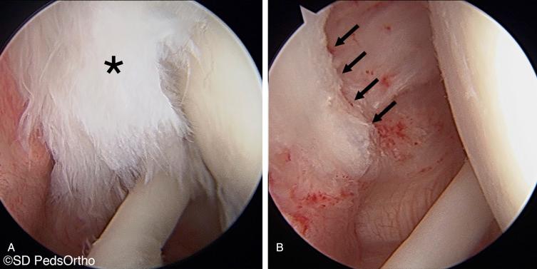 Fig. 19.4, A 13-year-old swimmer who presented with 2-year history of shoulder pain secondary to internal impingement, failed rest, and physical therapy to resolve pain. (A) Arthroscopic photo demonstrating a 4-mm supraspinatus articular tear (asterisk) . (B) Arthroscopic photo after debridement to stable edges (arrows) . She further underwent posterior capsulorrhaphy for instability to resolve and prevent further symptoms.