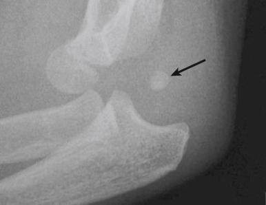 Fig. 19.5, Radiograph of a posterior elbow dislocation. The medial epicondyle is displaced and incarcerated in the joint.