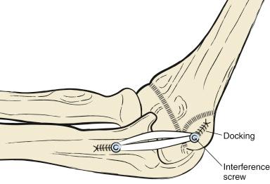 Fig. 19.6, Line drawing demonstrating the medial anatomy of the skeletally immature elbow with a double-docking screw fixation technique controlling the apophysis of the medial epicondyle during fixation of the proximal end of the medial ulnar collateral ligament reconstruction.