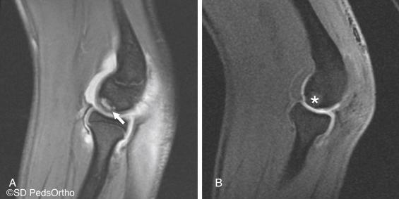 Fig. 19.7, A 16-year-old basketball player with recalcitrant capitellum osteochondritis dissecans. (A) Preoperative magnetic resonance imaging (MRI) (sagittal SPGR FS) demonstrating articular cartilage breakdown (arrow) , and (B) 3 months’ postoperative MRI with healed osteochondral allograft plug (asterisk) and restored articular cartilage surface (sagittal three-dimensional MERGE). SPGR , Spoiled gradient-recalled echo.