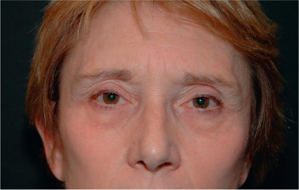 Fig. 38.1, This middle-aged woman has developed eyebrow ptosis as well as loss of orbital fat in her upper eyelid sulcus.