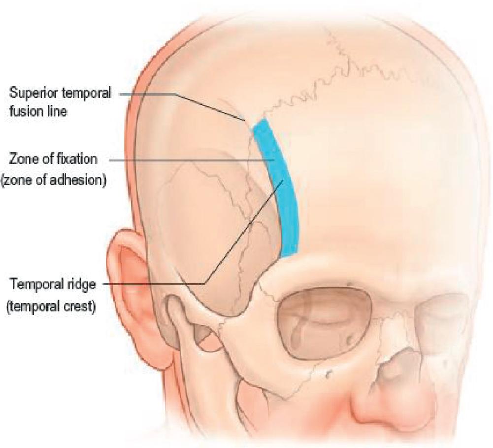 Fig. 38.2, The lateral portion of the frontal bone is crossed by a curved ridge called the temporal crest (also called temporal ridge or superior temporal fusion line of the skull ). This is a palpable landmark that separates the temporal fossa and the origin of the temporalis muscle from the forehead portion of the frontal bone. The blue band represents the zone of fixation (zone of adhesion) along which fascial layers are tethered to bone.