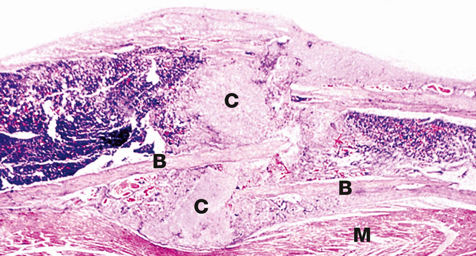 Fig. 10.9, Fracture callus