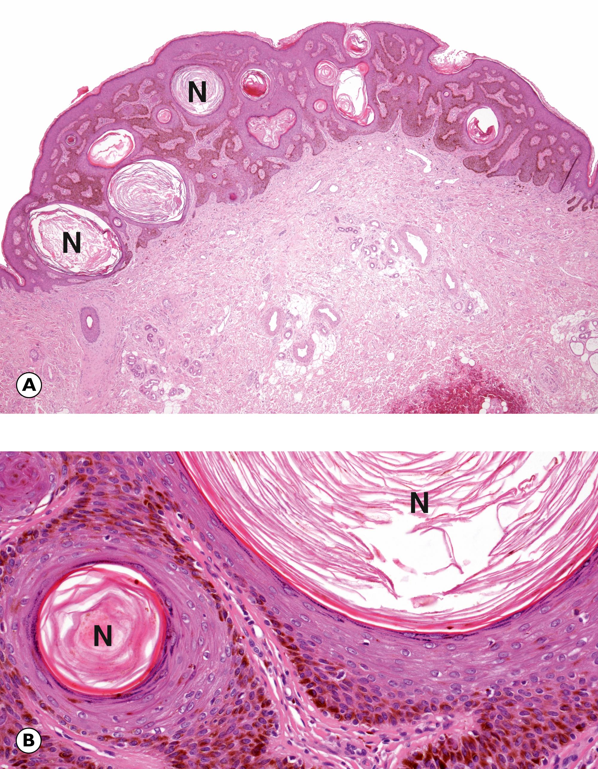 Fig. 21.11, Seborrhoeic keratosis. (A) LP; (B) HP.