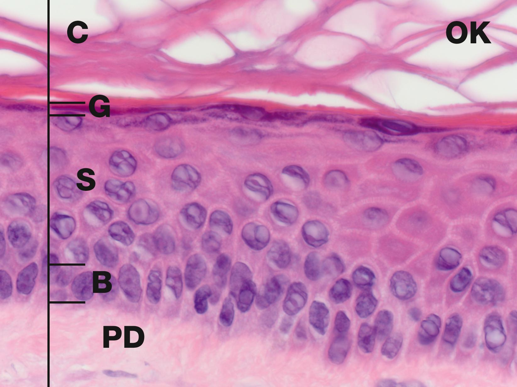 E-Fig. 21.1 H, Epidermis H&E (HP). The cells of the epidermis are called keratinocytes . The basal layer of keratinocytes (stratum basale) B proliferates continuously with repeated mitotic divisions. This provides cells for a progressive process of displacement towards the surface (upward migration), with associated maturation to renew the other layers. The basal cells are arranged as a single layer of cuboidal or low columnar cells. They are attached to the basement membrane (not seen in these preparations) on their dermal (basal) surface. This basal surface is irregular; the basal cells have a highly indented and folded basal cell membrane with numerous hemi-desmosomes. Superficially, the basal cells are attached to and mature into the cells of the stratum spinosum S which forms the majority of the epidermis. The stratum spinosum is also known as the prickle cell layer. It is multilayered and composed of polyhedral-shaped keratinocytes with round-oval nuclei, prominent nucleoli and cytoplasm, forming a pavement-like pattern. These cells synthesise cytoplasmic intermediate filaments called cytokeratins which accumulate in aggregates called tonofibrils made up of bundles of tonofilaments. These tonofibrils bind to the numerous desmosomes that form strong contacts between adjacent keratinocytes. The keratinocytes mature into the stratum granulosum G or granular layer. Here they acquire dense basophilic, keratohyaline granules which contain proteins rich in sulphur-containing amino acids (cysteine) and proteins such as involucrin which interact with the cytokeratin tonofibrils in the final maturation. The combination of tonofibrils with keratohyaline granule proteins produces keratin, in a process called keratinisation. Progressing towards the surface, the cells lose their nuclei and cytoplasm, becoming flattened interconnected keratin squames (plates/flakes of keratin) which comprise the surface coating of the skin, the stratum corneum C. These keratin squames connect at their edges, and in transverse sections form a folded basket-weave pattern called orthokeratosis OK. The squames are water repellent, in part because they are coated with lipid-containing anti-wetting agents synthesised during maturation in the granular layer.
