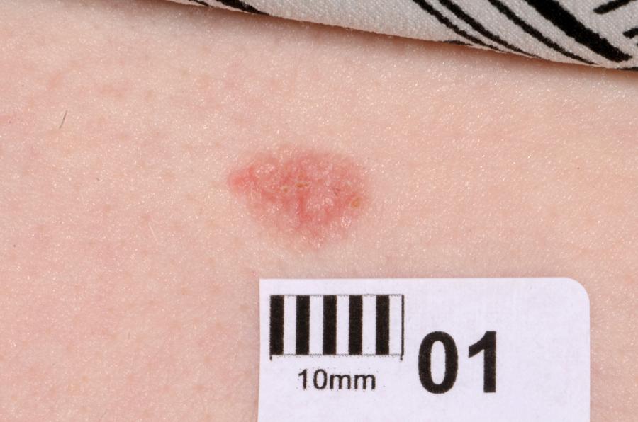 E-Fig. 21.8 G, Superficial basal cell carcinoma.