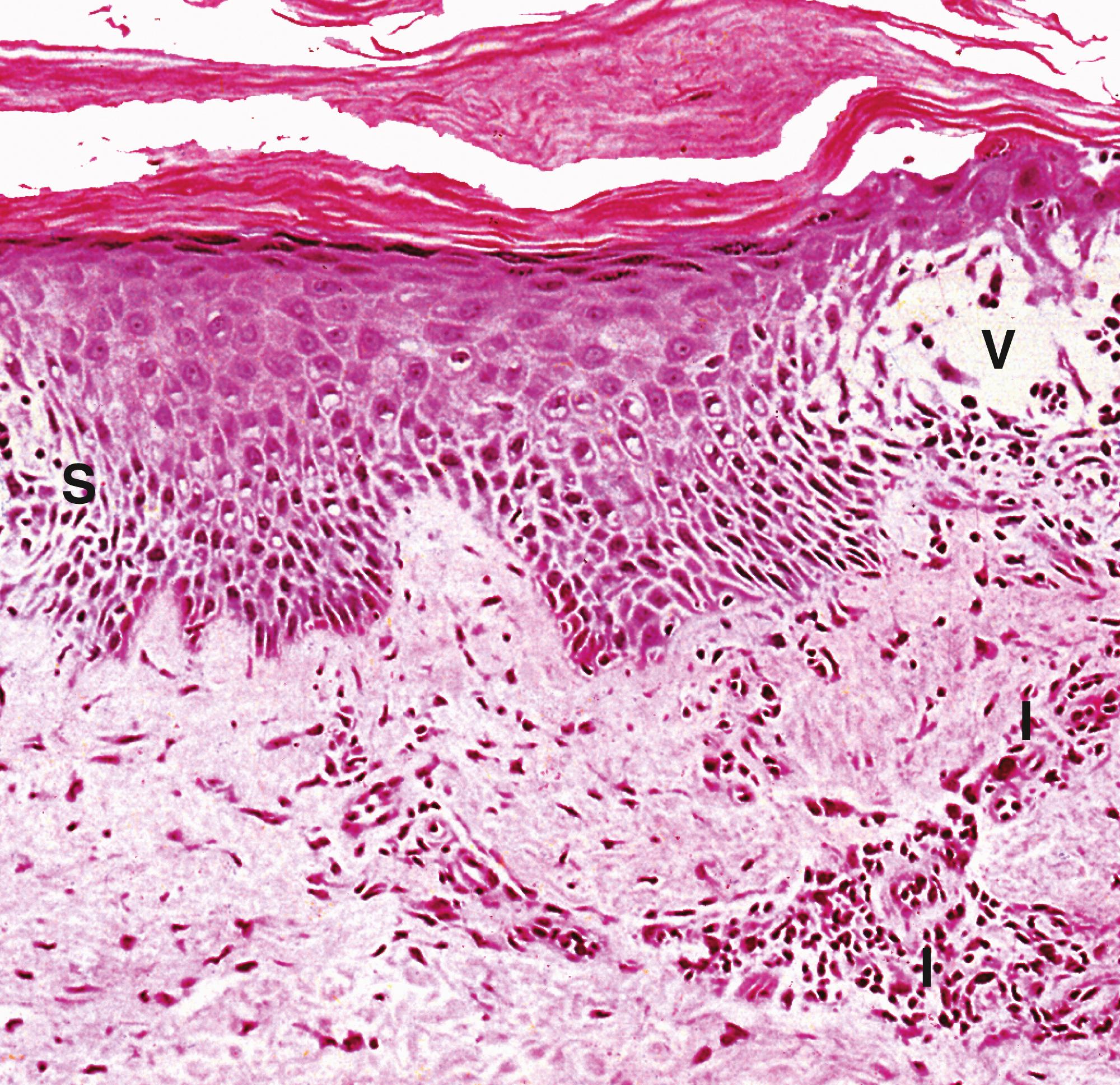 Fig. 21.5, Acute dermatitis (MP).