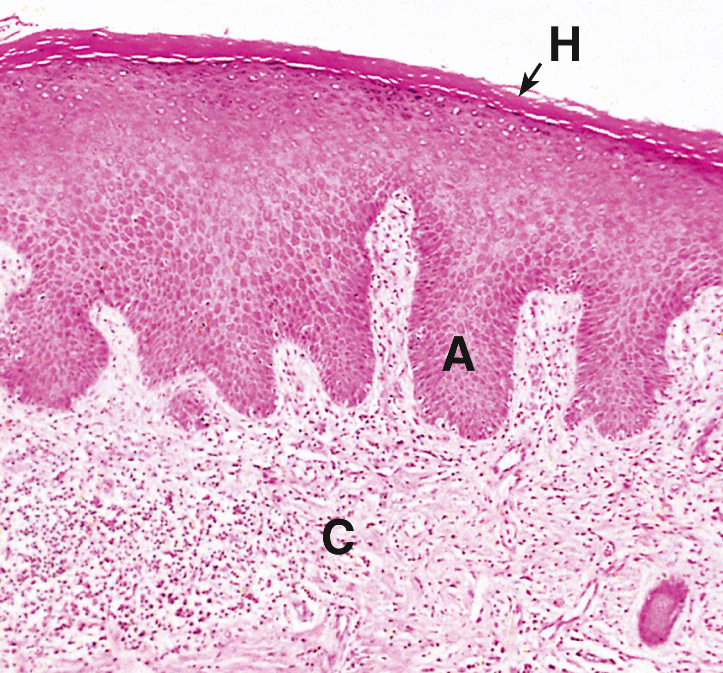 Fig. 21.6, Chronic dermatitis (MP).