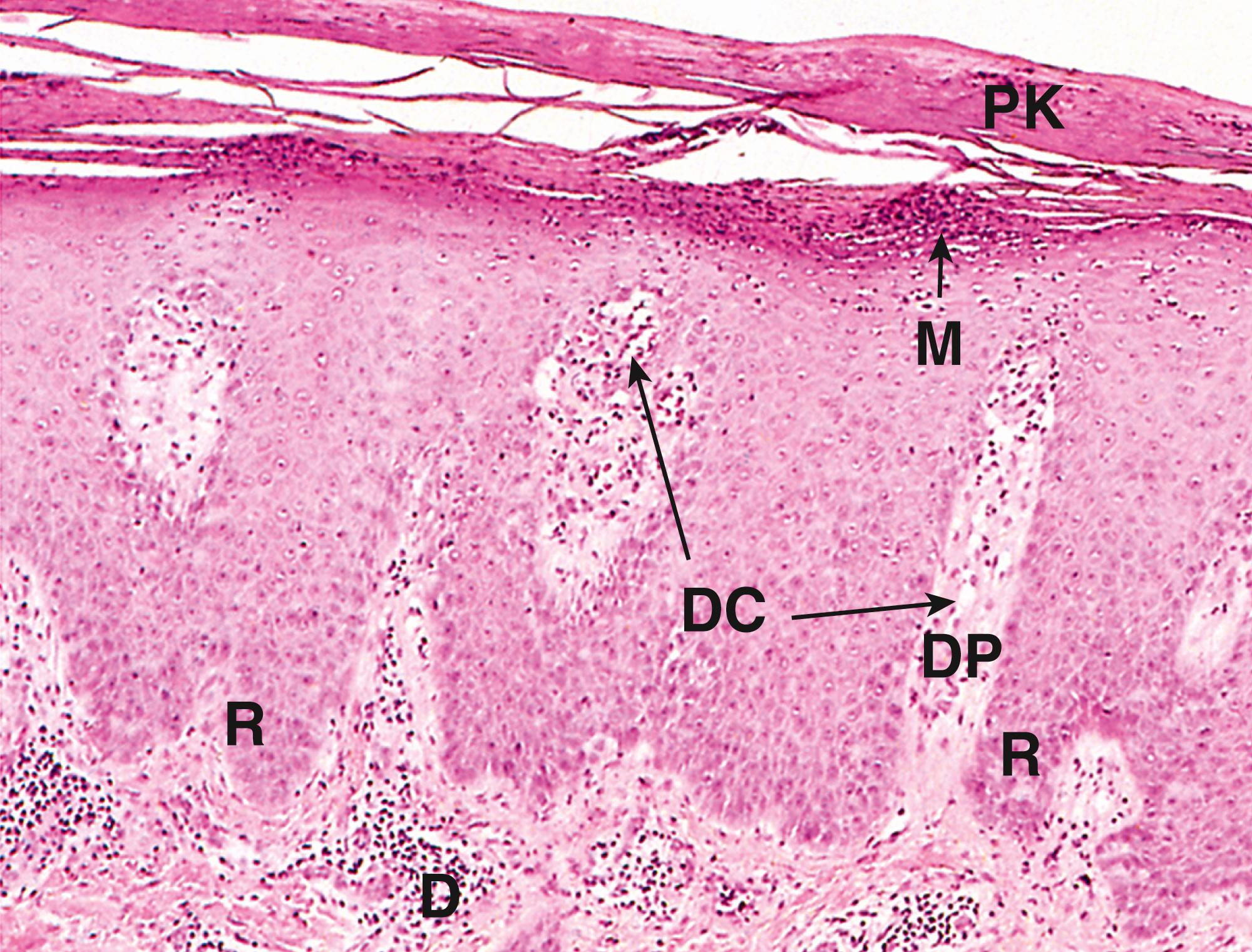 Fig. 21.8, Psoriasis (MP).