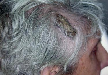 FIGURE 11.1, Crusted lesion on the right temporal scalp.