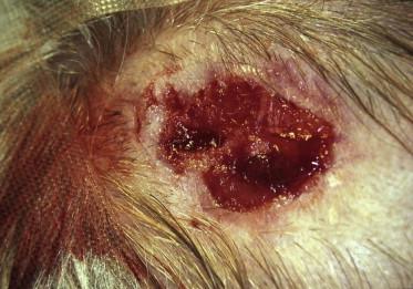 FIGURE 11.2, Crust removed to reveal the extent of the ulcerated tumor.