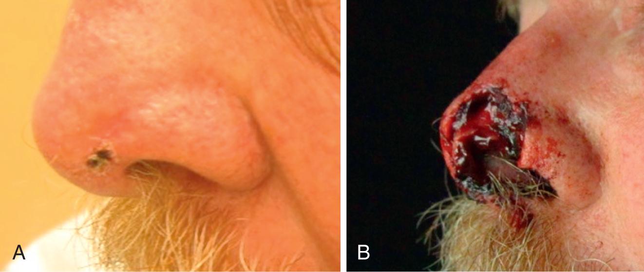 Fig. 12.5, Before and after Mohs microscopic surgery (MMS).