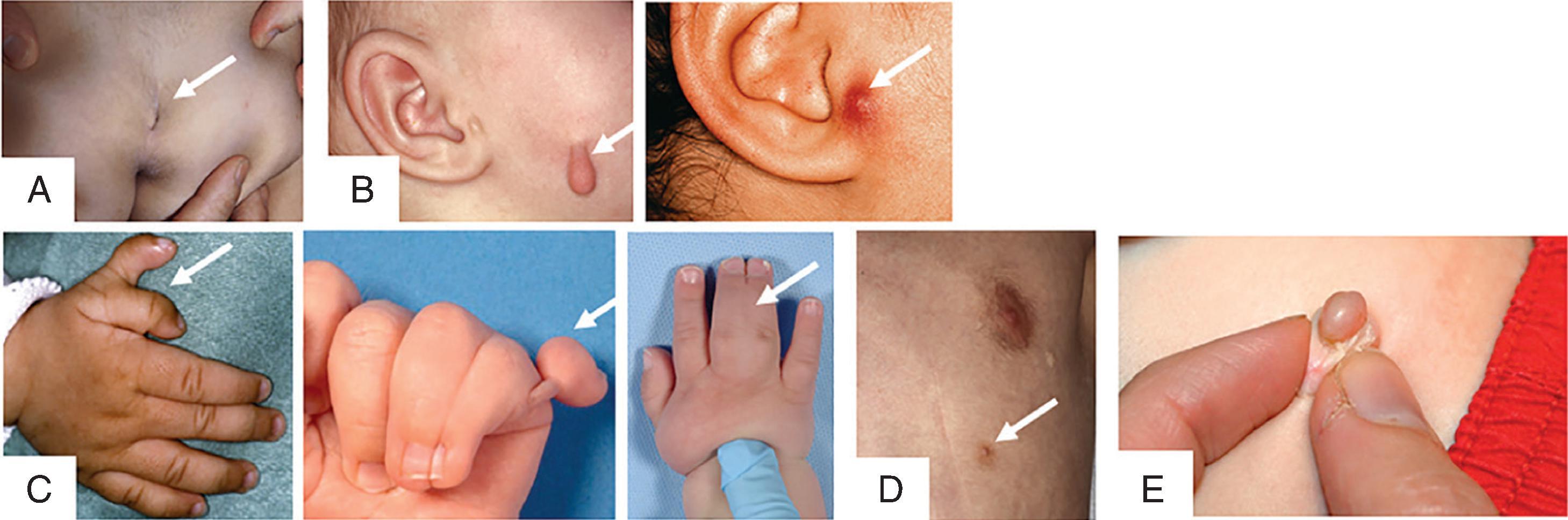 Fig. 102.13, Minor Congenital Anomalies .