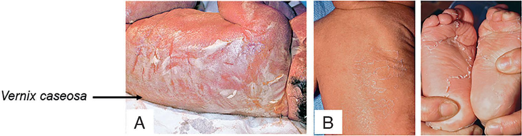 Fig. 102.2, Normal Postnatal Changes in Skin .