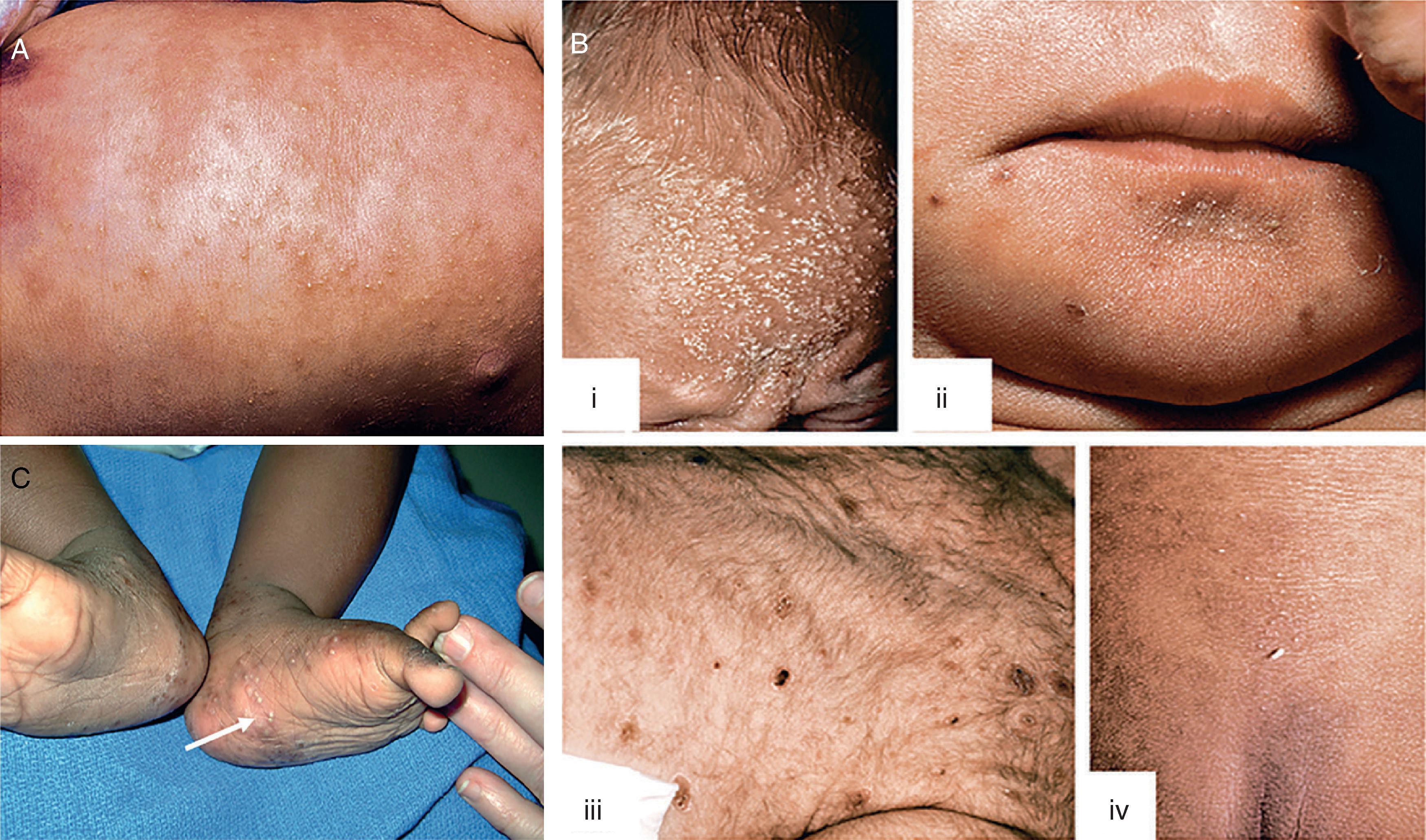 Fig. 102.6, (A) Erythema toxicum neonatorum. Numerous yellow papules and pustules are surrounded by large, intensely erythematous rings on the trunk of this infant. (B) Transient neonatal pustular melanosis. (i) Numerous tiny pustules dot the forehead and scalp of this light-pigmented neonate. (ii) Healing pustules leave marked hyperpigmentation and scales on the chin of this dark-pigmented baby. (iii) Dry, hyperpigmented crusts cover the back of this Asian newborn. (iv) Healing pustules and brown macules dot the lower back and sacrum of this child at birth. Note the Mongolian spot on his gluteal cleft. (C) Acropustulosis of infancy. Multiple 2- to 3-mm pustules covered the hands and feet of this otherwise healthy infant. Lesions recurred episodically until this child was 3 years old.