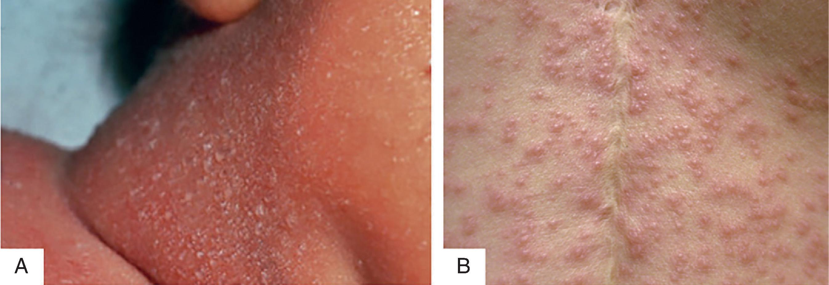 Fig. 102.9, Miliaria .