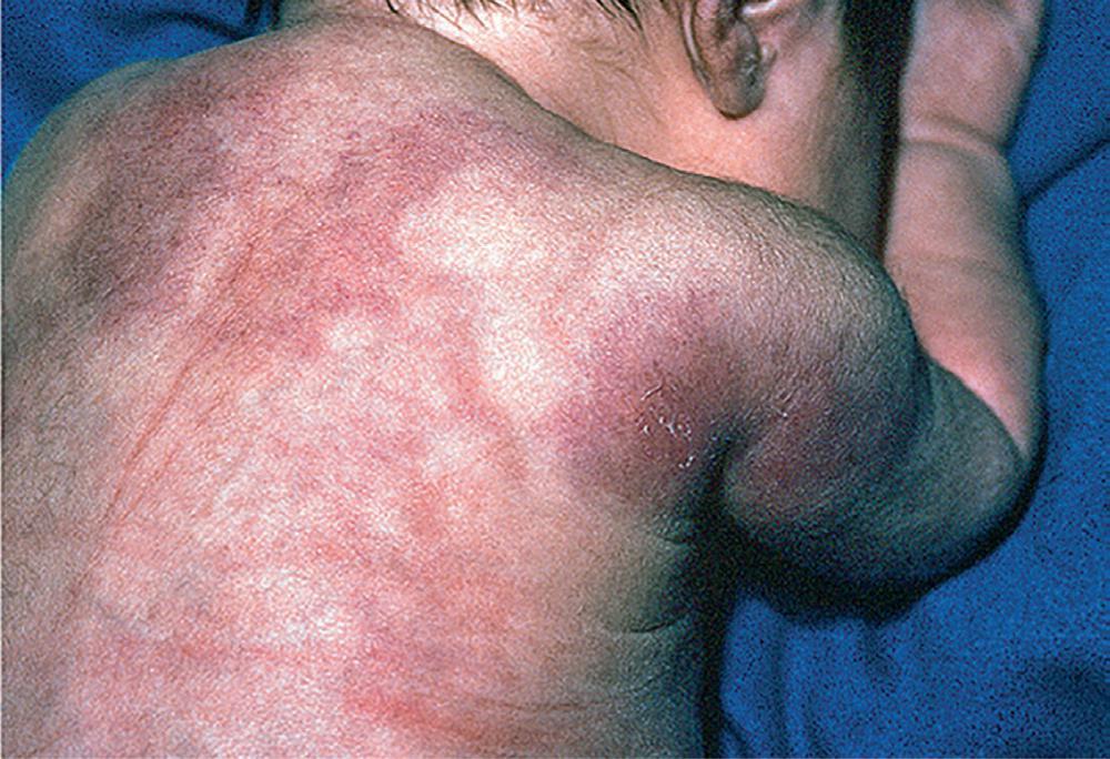 Fig. 102.10, Annular Erythema of Infancy .