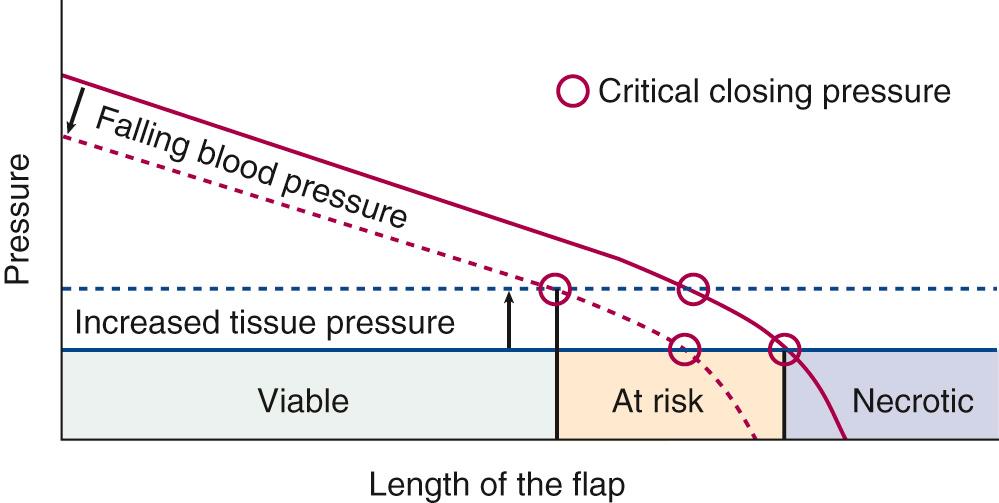 Fig. 77.1, Effect of flap length and tissue pressure on flap blood flow.