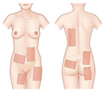 F igure 87-1-2, Split-thickness donor sites. Split-thickness donor sites are commonly chosen from the anterior thigh or abdomen. Color-matched and aesthetically less evident areas can only be chosen if healthy skin is available. In burn patients with only limited availability of nonaffected skin, skin will be taken from any part of the body. Face and hands are preferentially spared from skin harvest.