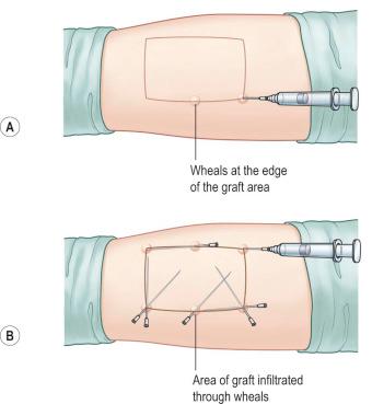 F igure 87-1-3, A, B, Donor site preparation. Bleeding is one of the most important complications of excision and grafting. To reduce the severity of bleeding during excision, the fatty tissue under the graft can be infiltrated with a solution of epinephrine diluted in saline (“tumescent technique”).