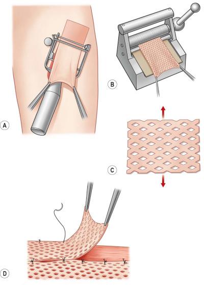 F igure 87-1-5, Split-thickness harvest and grafting. A, Split-thickness skin graft (STSG) harvest with an electrically driven dermatome at the anterior thigh. B, The skin graft should be positioned flat on the mesh template: this can be perforated by multiple slits to C, expand the graft up to six times its original size. D, Meshed STSGs are ideal to cover large and uneven wounds. Stapler fixation is a time-saving method to fix large grafts.