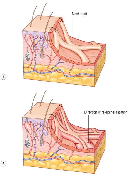 F igure 87-1-6, Meshed split-thickness skin graft (STSG) and re-epithelialization. The pattern of the meshed STSG is evident even after completely healed skin and is more evident with the enlargement ratio used. Therefore, surgeons possibly prefer to expand with 1 : 1.5–1 : 2 ratios as maximum. A, The meshed skin graft can be fixed with staplers or sutures. B, Open surfaces will be gradually re-epithelialized from the skin stripes. In largely expanded grafts the stimulation of the wound bed from the engrafting cells leads to hypergranulation, resulting in an unpleasant aesthetic pattern.