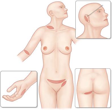 F igure 87-1-7, Full-thickness donor sites. Full-thickness skin graft (FTSG) donor sites are limited and require primary wound closure or split-thickness skin grafting after harvest. FTSGs are indicated in the reconstruction of smaller lesions in aesthetic (face) or functional areas (hand). Larger FTSGs can be taken from the buttock fold and the infra-abdominal fold. Ideal for reconstruction of the hand is the hypothenar area and the anterior wrist fold. The main axis of the elliptically shaped hypothenar graft should be positioned slightly dorsal to the glabrous-skin border to avoid a hypersensitive scar. For face reconstruction, FTSGs are taken from the retroauricular or, often used in children, the superior eyebrow regions for optimal color match. The inguinal fold is frequently used because of good aesthetic outcome at the donor site. Other areas are the subclavicular, the infra-abdominal, and the elbow fold as well as the inner upper arm.