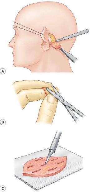 F igure 87-1-8, Full-thickness skin graft (FTSG) harvest and preparation. FTSGs should be designed elliptically to achieve primary wound closure without deforming surrounding tissues. This fact is usually given if a length: width ratio of 1 : 3 is followed. A, After sharp excision of the graft the surgeon should elevate the graft if possible without fat tissue and protect the graft by handling it with a skin hook or anatomical forceps. B, Defatting is an important process to avoid fat necrosis after grafting and to facilitate direct revascularization of the wound bed. The graft can be easily defatted with scissors by stretching the graft upside down over the index finger. C, To allow fluid exit from the wound bed, FTSGs should be incised with a sharp knife in multiple sites.
