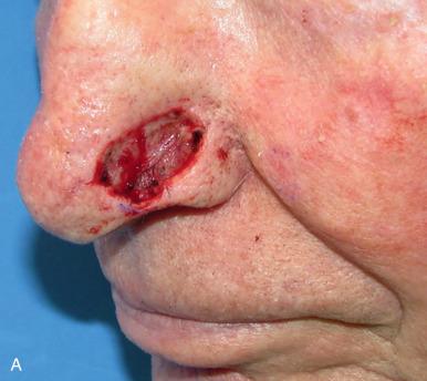 Fig. 9.1, Harvesting a full-thickness skin graft (FTSG). (A) Defect following Mohs micrographic surgery for basal cell carcinoma. (B) The preauricular donor site. (C) The FTSG sutured into place with interrupted 6-0 polypropylene sutures; note the tacking sutures within the alar crease. (D) Three-month follow-up view of an FTSG.