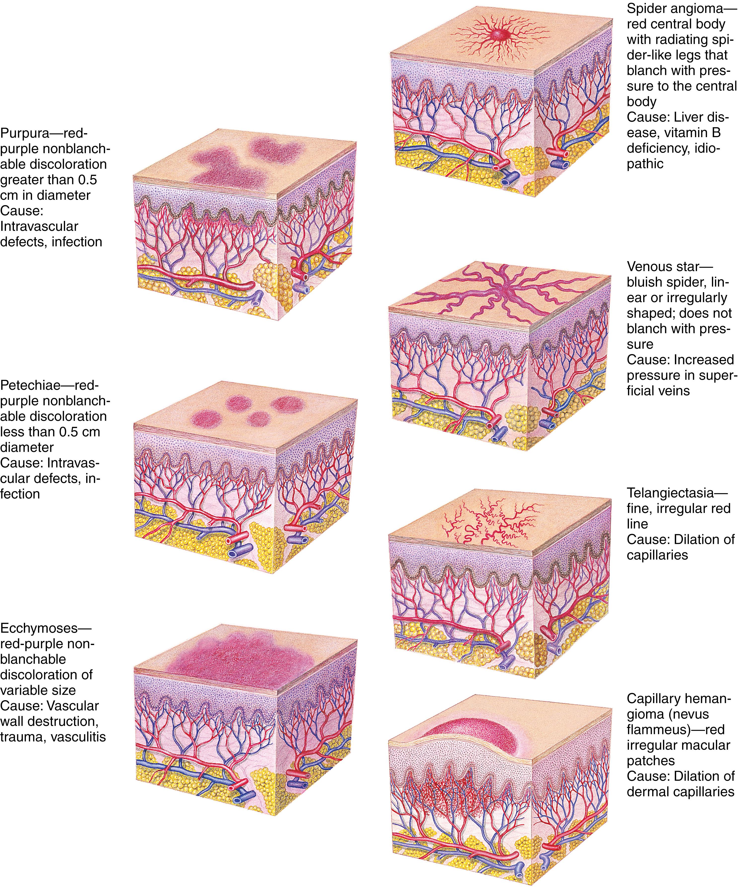 Fig. 9.10, Characteristics and causes of vascular skin lesions.