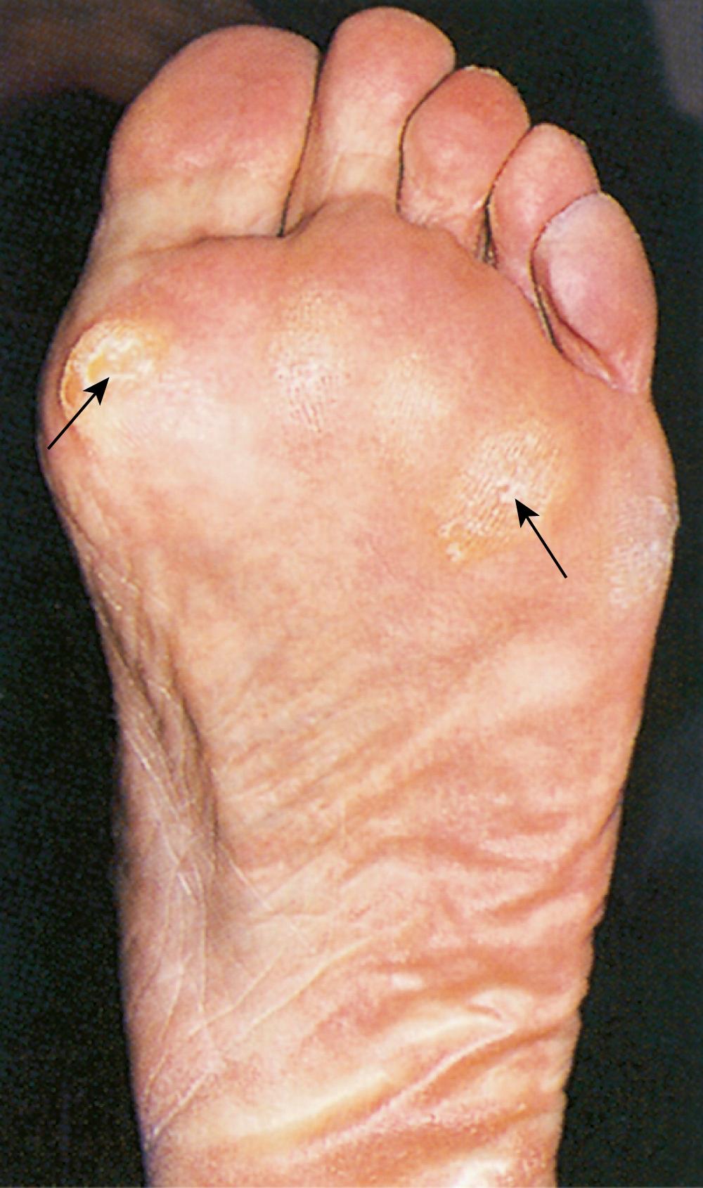 Fig. 9.4, Callus under the metatarsophalangeal joints.