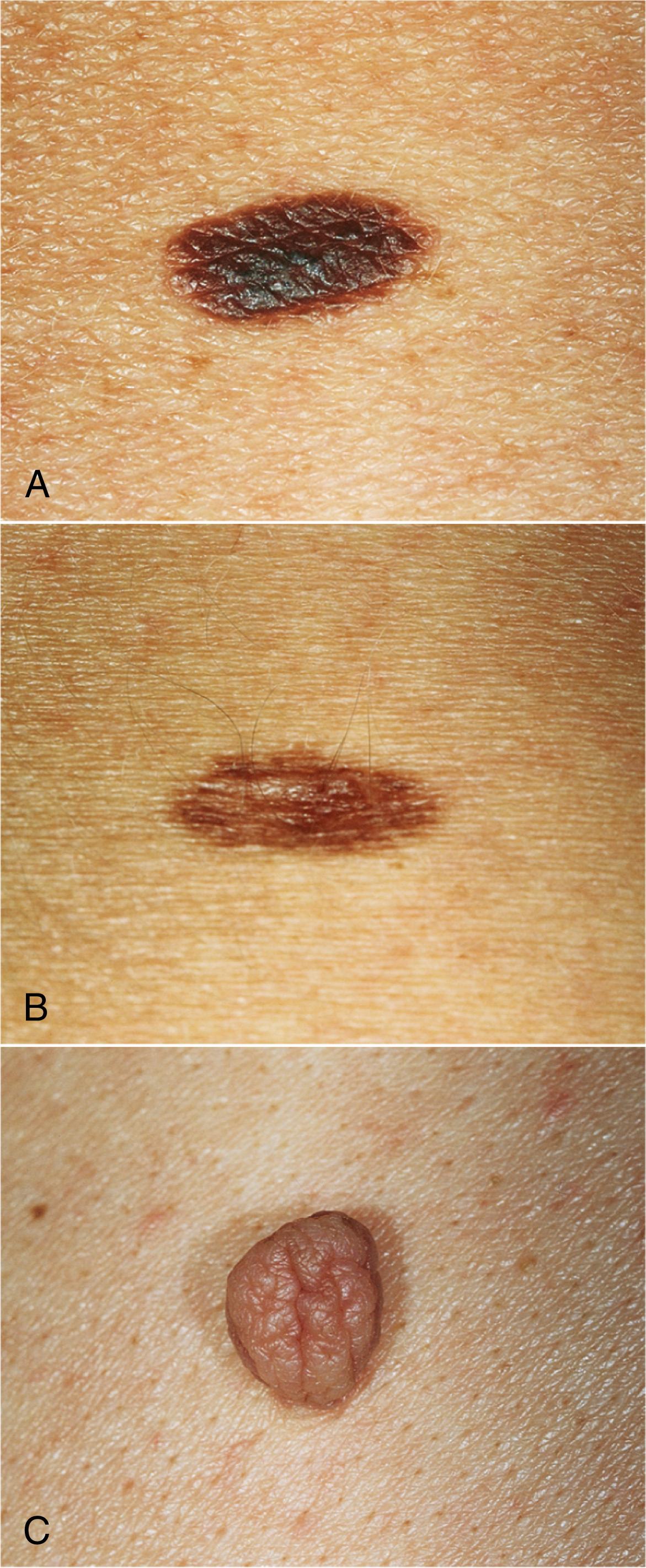 Fig. 9.5, Commonly occurring nevi.